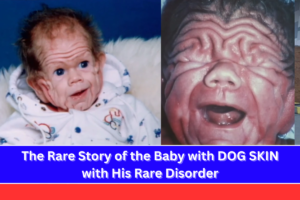 The Rare Story of the Baby with DOG SKIN with His Rare Disorder